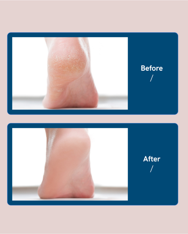 SmoothFeet™ Pedicure Foot Grinder - Image 8